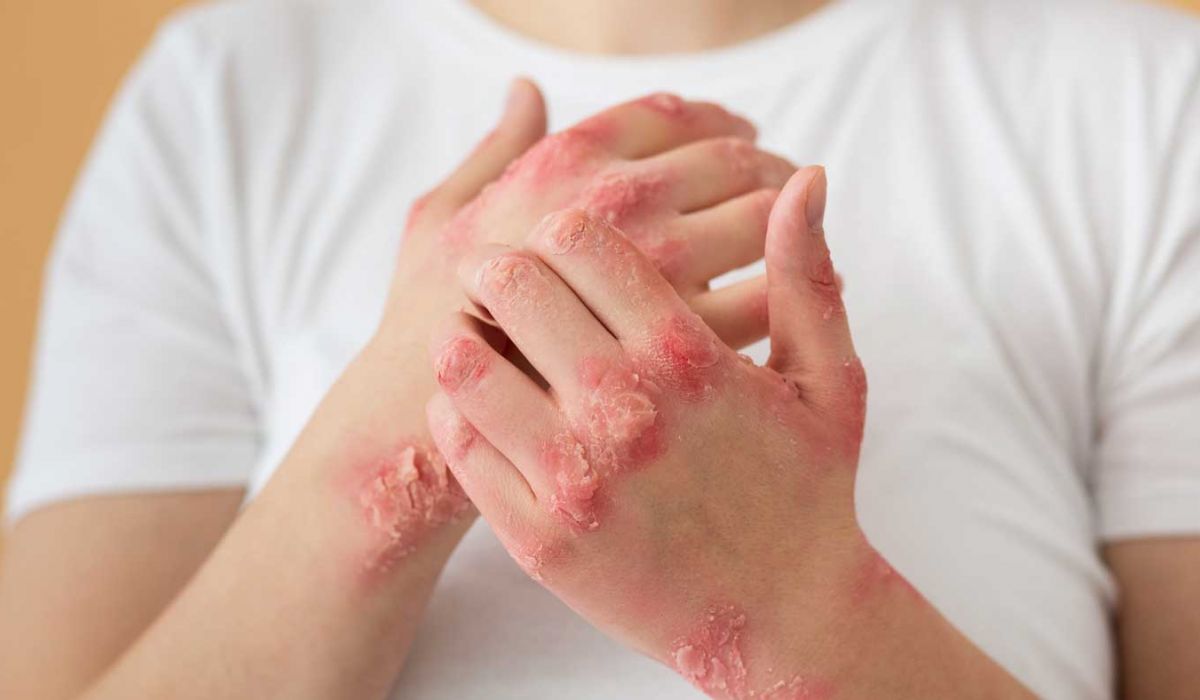 Die Hand–Fuß–Mund–Krankheit - Was Eltern wissen sollten